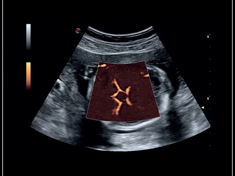 MyLab™Sigma - Fetal Willis circle with Power Doppler