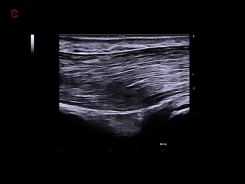 MyLab™C25 - IHX muscle
