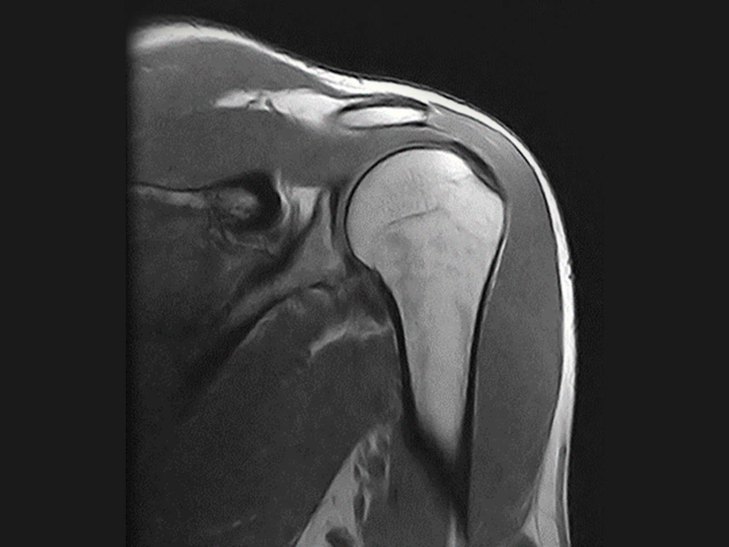 Magnifico™Open - Shoulder SE T1 coronal