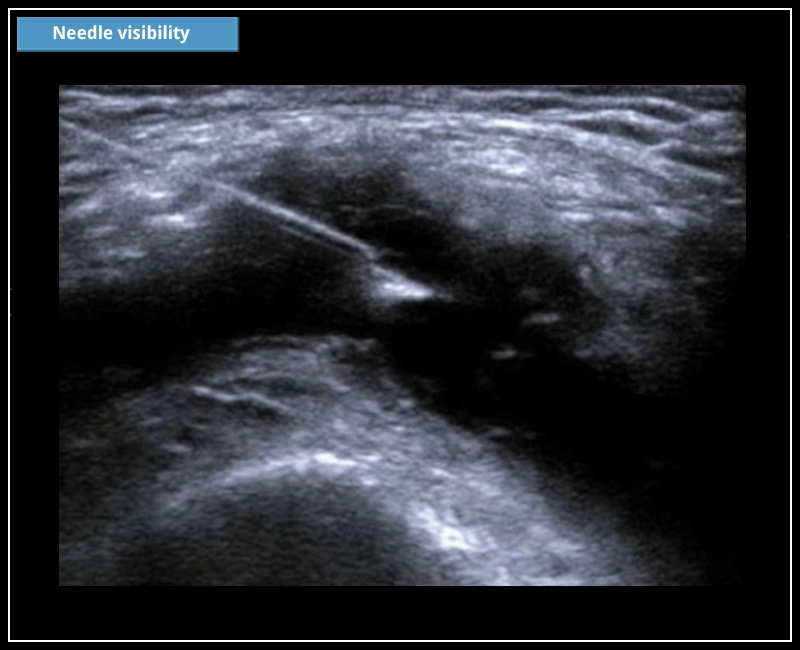 MyLab™X6 - Needle Visibility