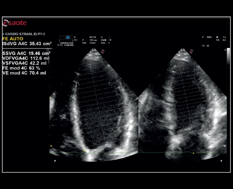 MyLab™X8 Platform - Zero-click EF measurement with Uterus - XLight 3D/4D exploration AutoEF