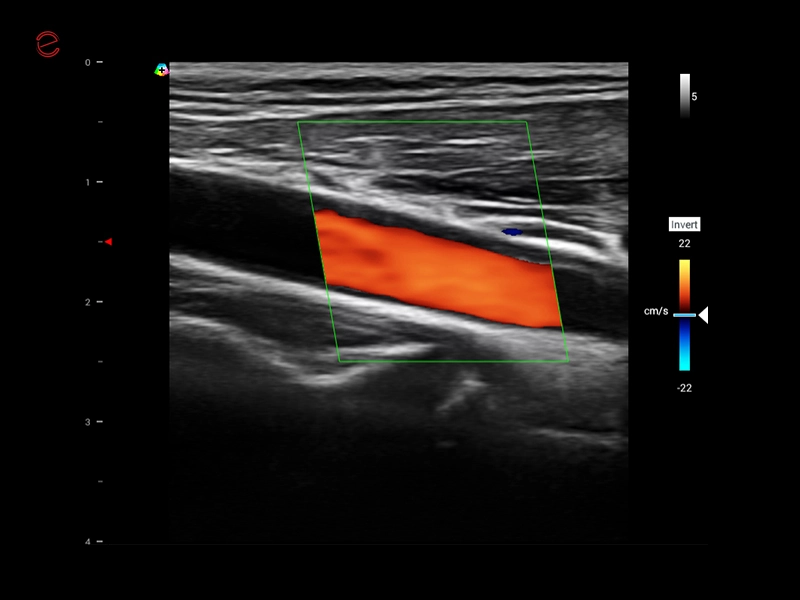 MyLab™X1 Go - CV Vascular