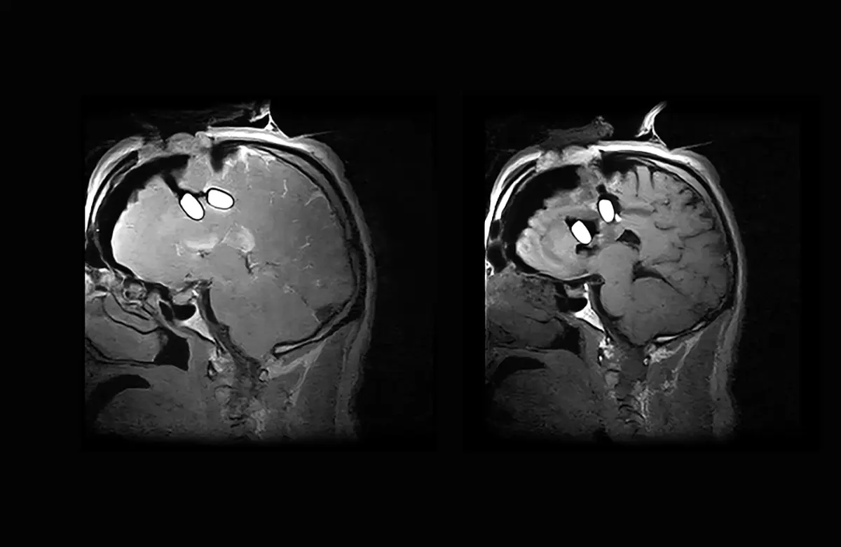 Esaote MRI available during surgery