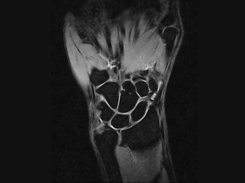 Magnifico™Open - Wrist Sped coronal