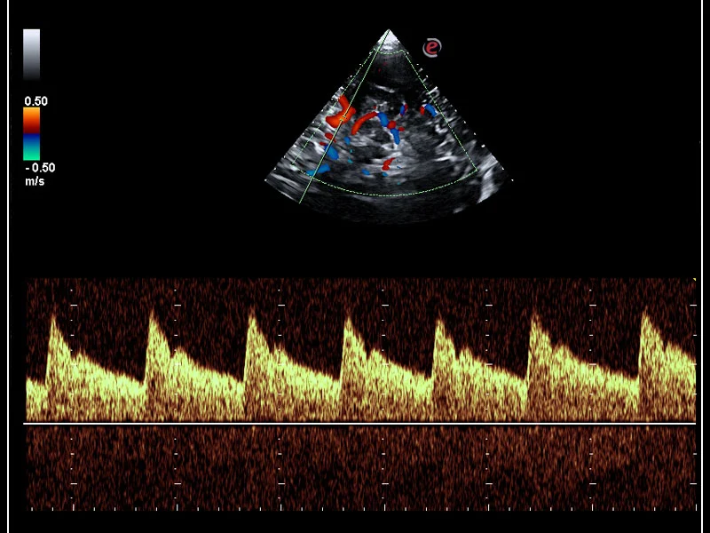 MyLab™Omega - Transcranial doppler