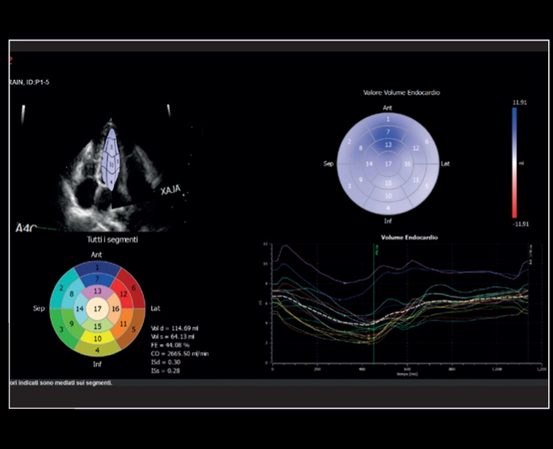 MyLab™X8 Platform - Volumetric model of the left function with XStrain4D
