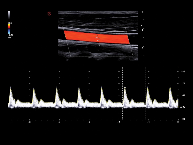 MyLab™A50 - vascular PW