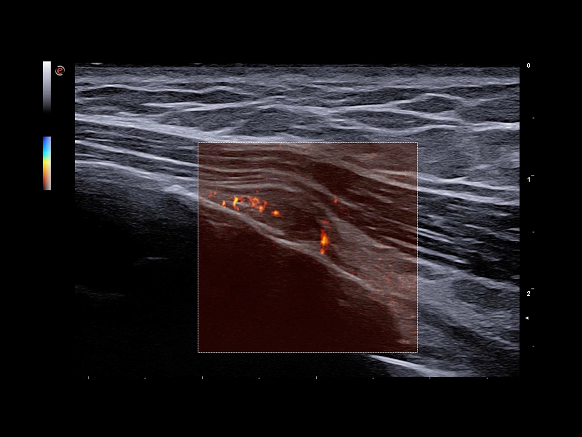 No limits to the visualization of microvascularization
