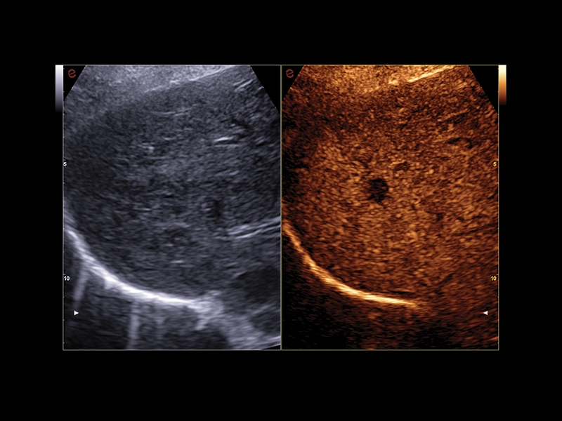 MyLab™A50 - Liver CnTi