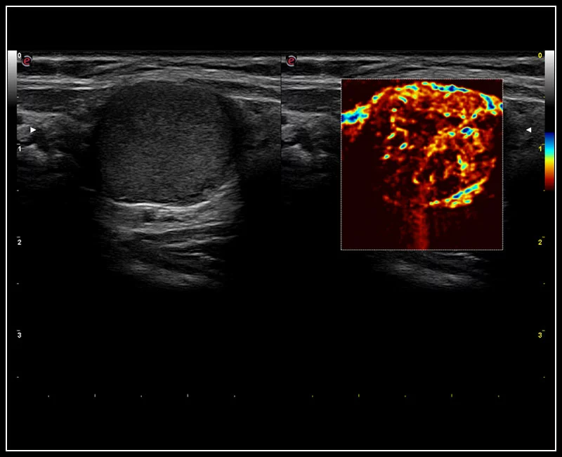 MyLab™9 Platform - Advanced hemodynamic analysis in thyroid nodule with microV