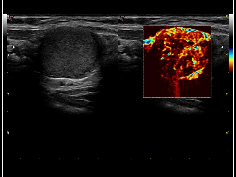 MyLab™9 Platform - Advanced hemodynamic analysis in thyroid nodule with microV