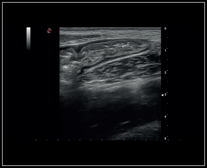 MyLab™Sigma - High Frequency Imaging B-mode of Intestine