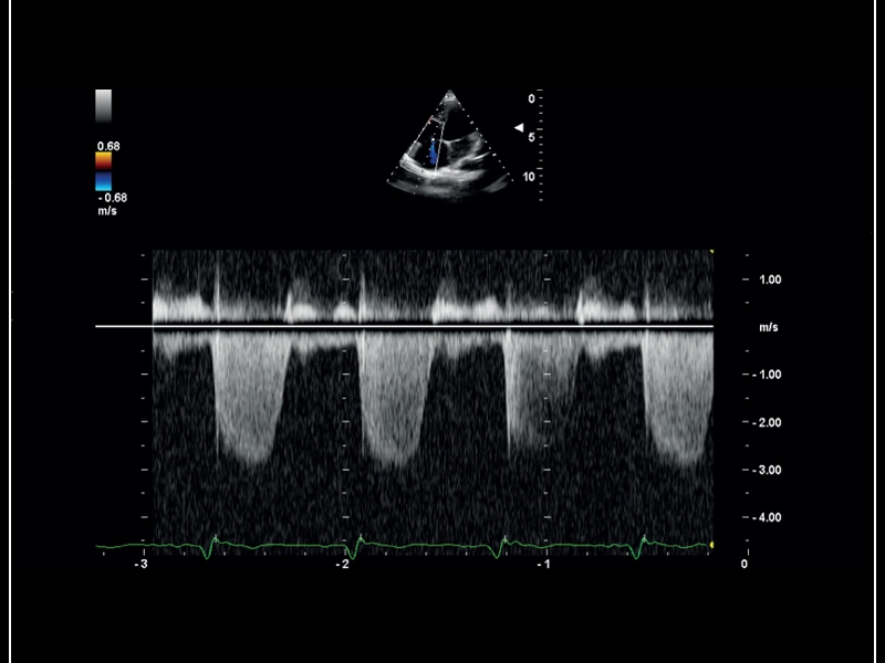MyLab™Sigma - CW Doppler of Tricuspid regurgitation