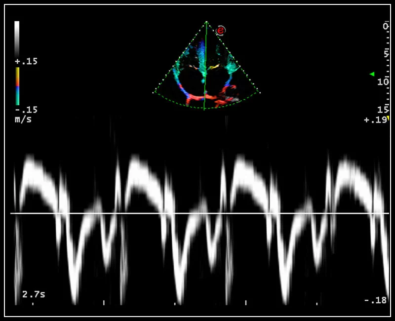MyLab™9 Platform - Tissue Velocity imaging to quantify septal velocity and dyssynchrony