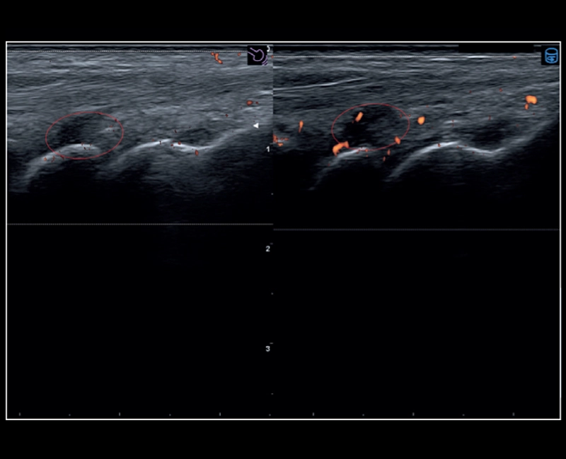 MyLab™X8 Platform - Evolution of the inflammation with Follow Up and Q-Pack
