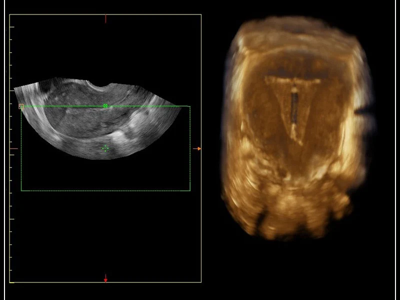 MyLab™Omega - IUD visualization using 3D endocavitary probe