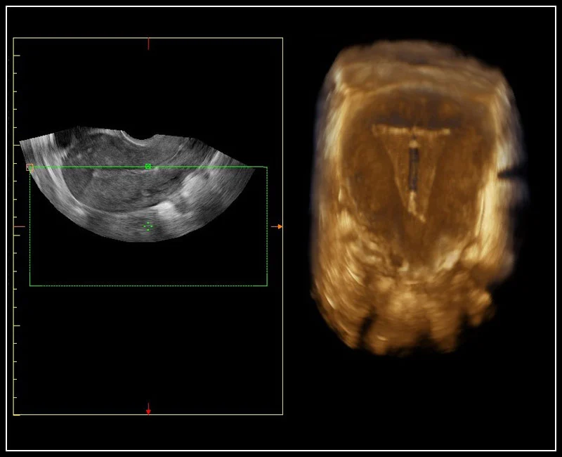 MyLab™Omega - IUD visualization using 3D endocavitary probe
