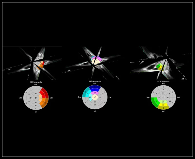 MyLab™9 Platform - XStrain4D technology for volumetric heart assessment by coronary territories