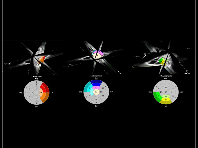 MyLab™9 Platform - XStrain4D technology for volumetric heart assessment by coronary territories
