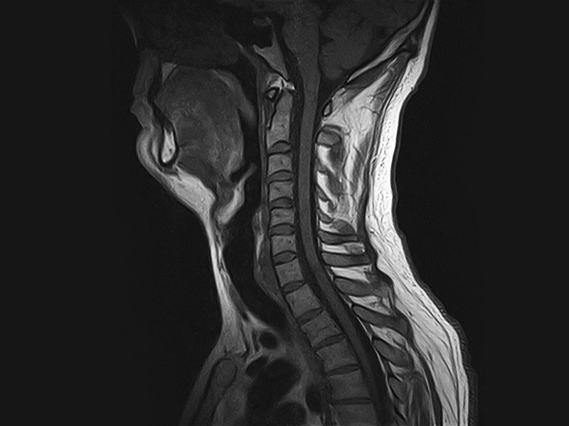 Magnifico™Open - Cspine SET1 sagittal