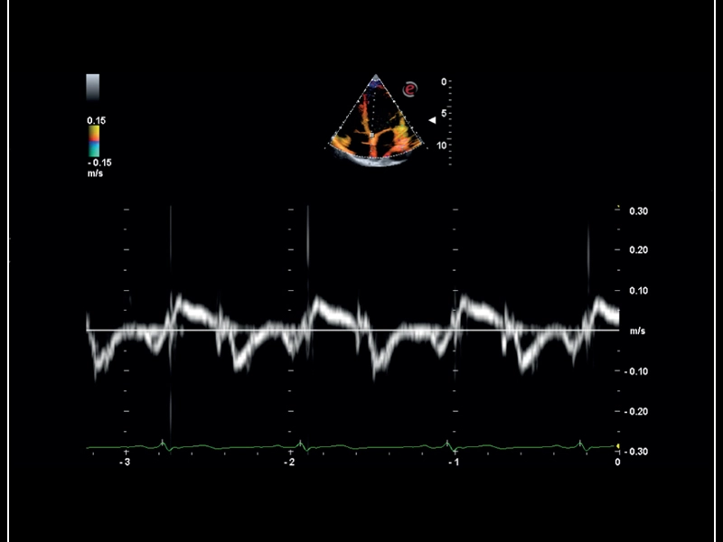 MyLab™Sigma - Mitral valve posterior leaflet analysis with Tissue Velocity Mapping