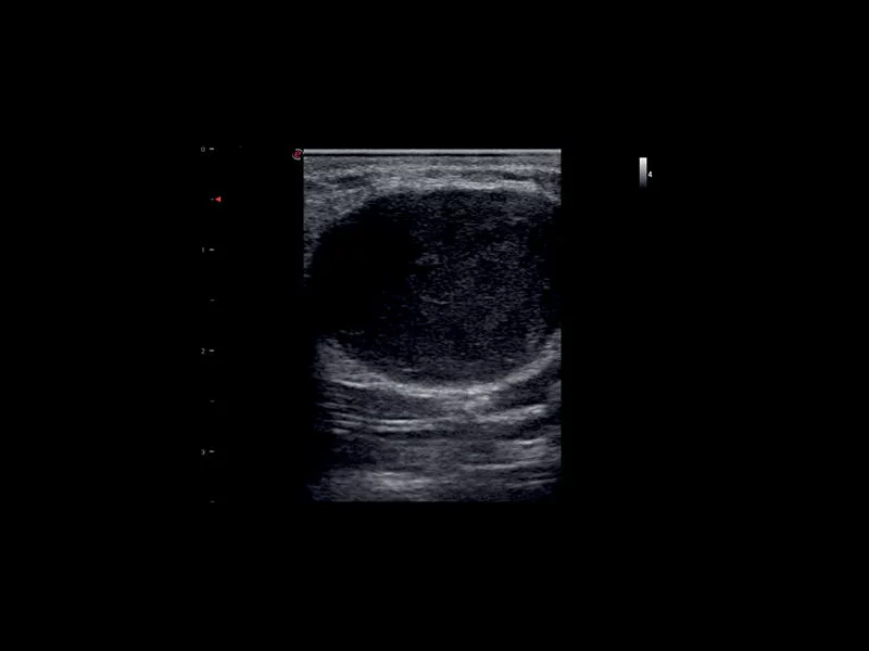 MyLab™X1 - Neck-lump