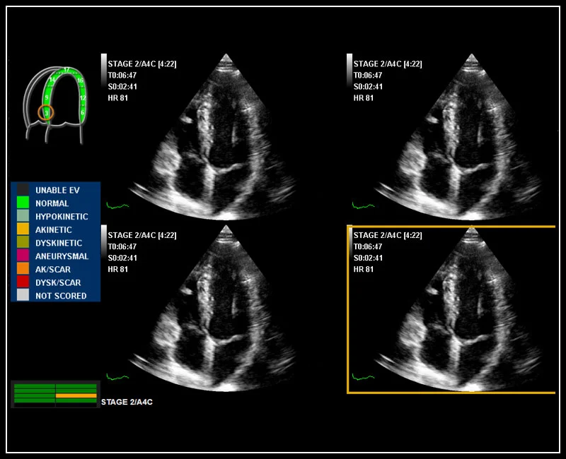 MyLab™Omega - Stress Echo