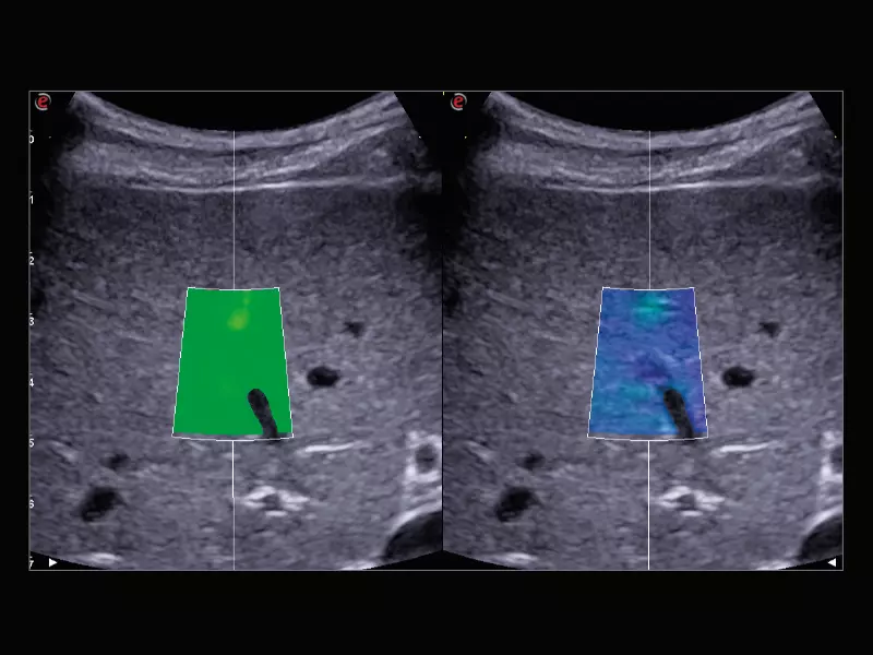 MyLab™X9 - Liver 02