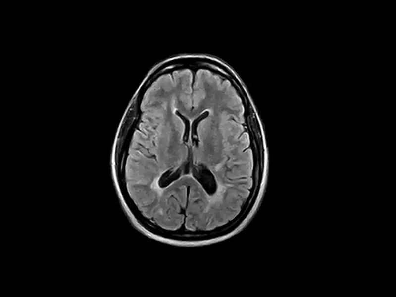 S-scan Open - FFLAIRax head