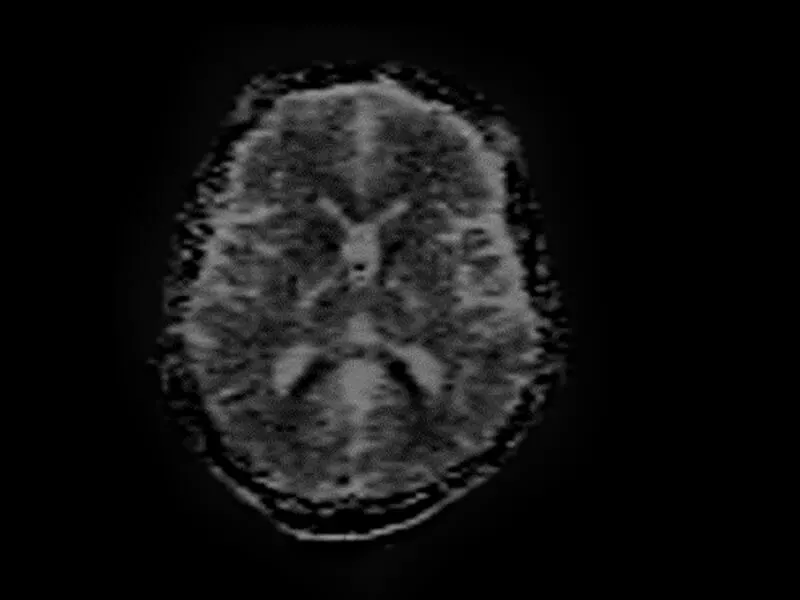 Magnifico™Open - DWI 3