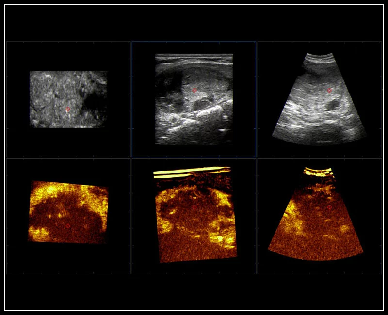 MyLab™9 Platform - Pre-Post volumetric CEUS-multidataset comparison