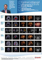 Contrast enhanced ultrasound (CEUS) in secondary liver cancer
