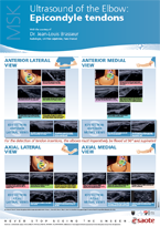 Ultrasound of the Elbow: Epicondyle tendons