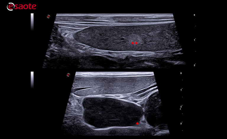 abdominal lymphadenopathy
