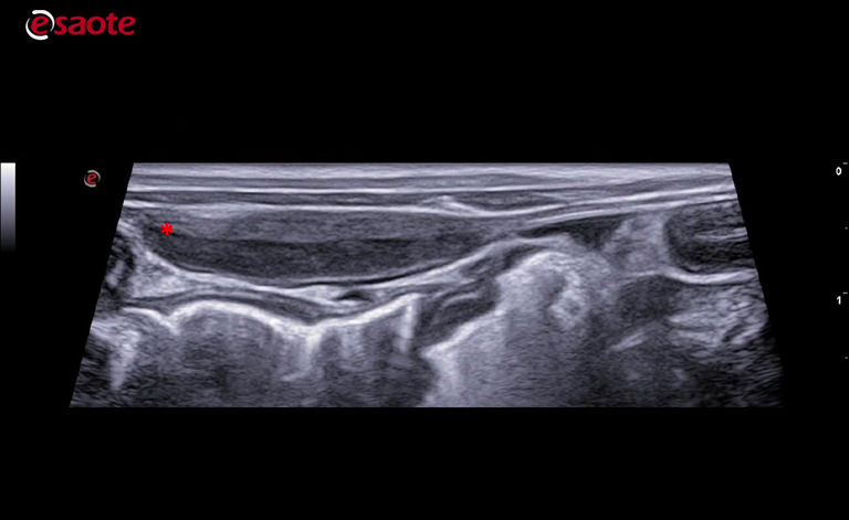 diffuse peritoneal scattering with little accumulation of anechoic effusion