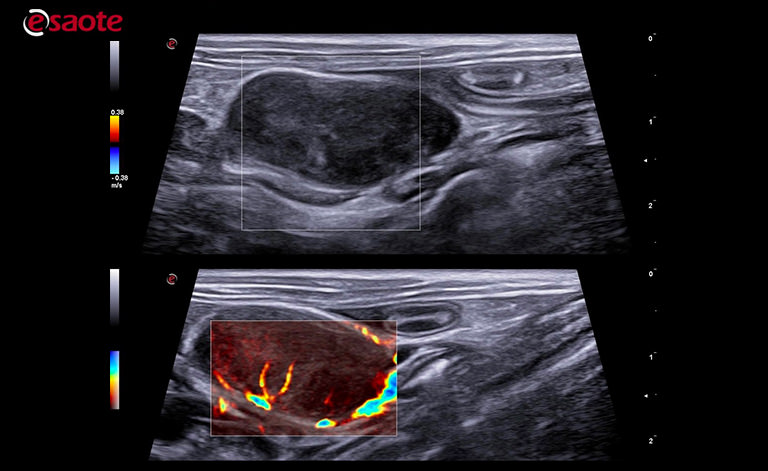 lymph node vascularization