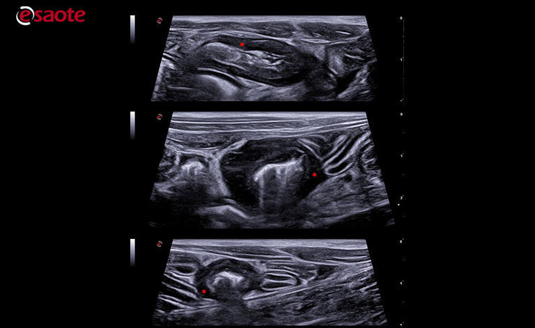 multifocal wall thickening with eccentric growth