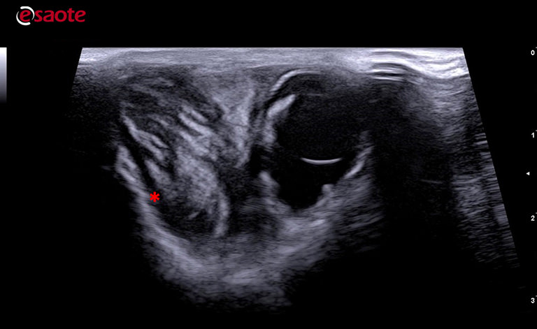 neoformation on the lateral aspect of the orbital cavity