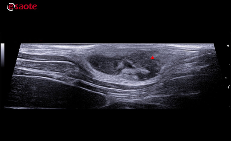 two subcutaneous lesions