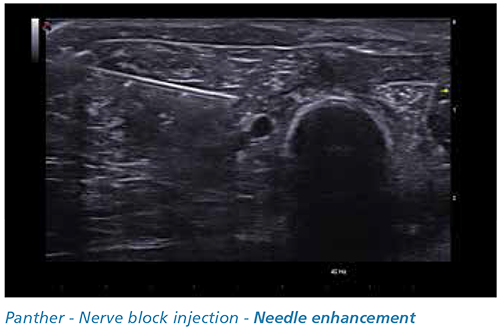 Pantera - injeção de blocos nervosos - Needle enhancement