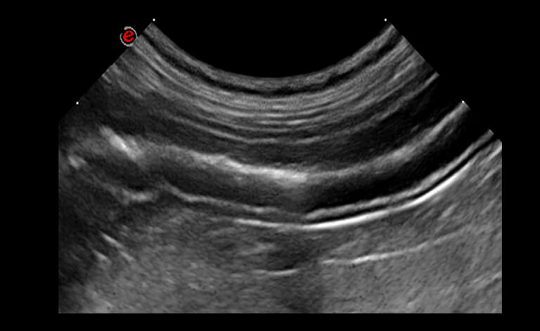 physiological stratigraphy of a jejunal loop