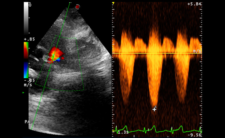 Right parasternal window, continuous wave spectral Doppler