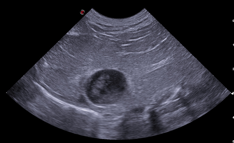 Next, an abdominal ultrasound with microconvex (Freq 3-11 MHz) and linear (Freq 4-15 MHz) probes was performed.