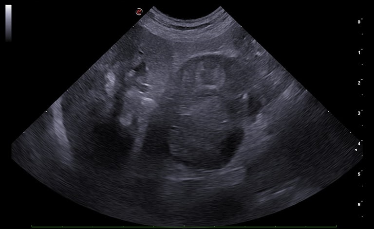 The right adrenal gland is markedly increased in thickness (3.3 cm) due to the presence of a heterogeneous mass which destructures its morphology
