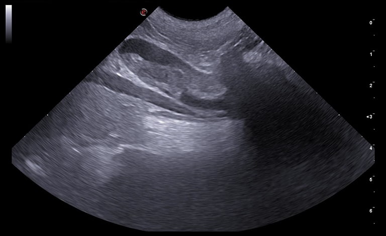 In the aorta, caudal to the branch of the renal artery ...