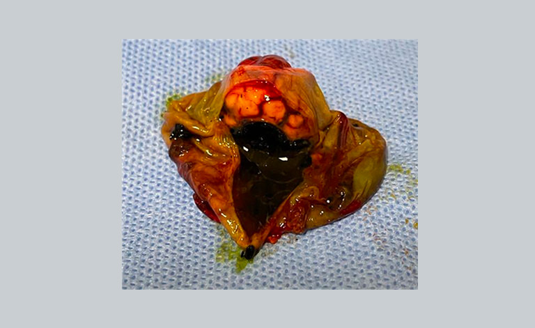 In this scan, the concentric structure is apparent, where the outer wall probably part of the colon...
