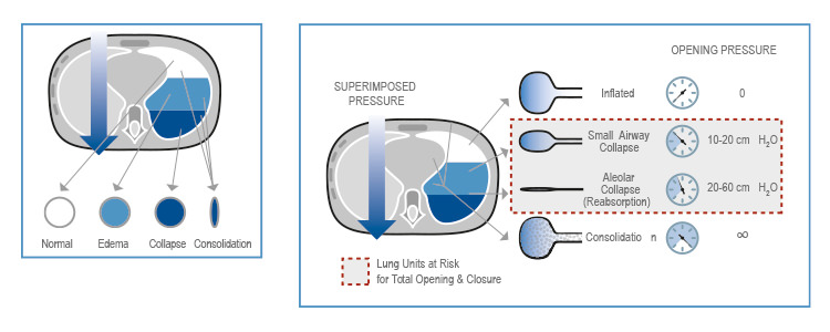 LUS for monitoring mechanical ventilation