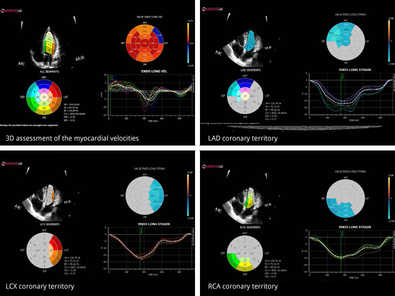 Speckle-Tracking Echo for Assessment of Myocardial Strain: A Case in Images  – Consult QD