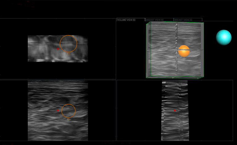 3D-локализация образования с помощью BreastNav