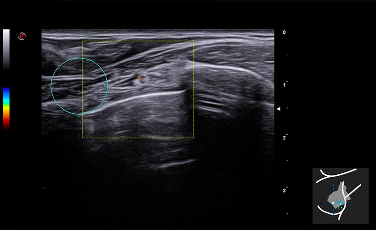 Технология микроусиления microE с BreastNav